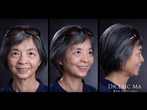 看Dr. Eric Ma馬永昌醫師如何運用先進數位牙醫流程”數位微笑設計“與”電腦斷層導引植牙”在一日內打造逆齡二十年氣質貴婦微笑曲線！ | 在丰采美學牙醫，我們改變患者的人生