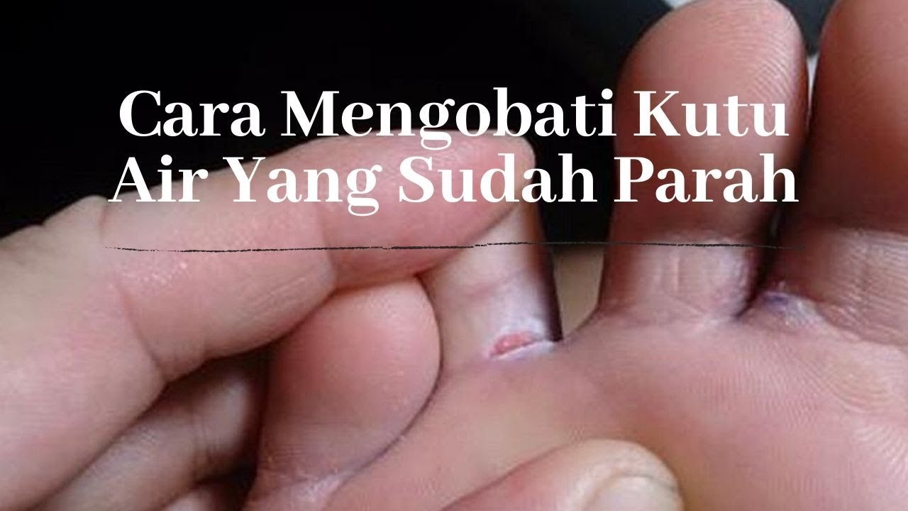 Cara Mengobati Kutu Air Yang Sudah Parah