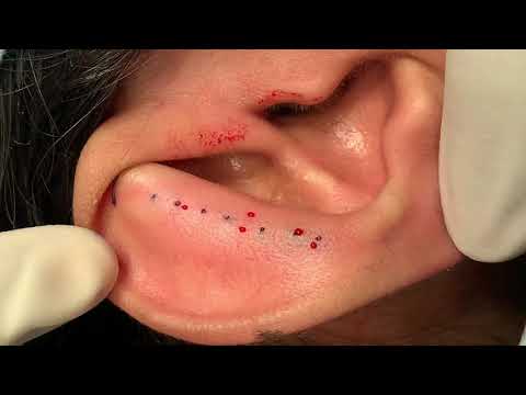 Video: Otoplasty: Calon, Prosedur, Risiko, Biaya