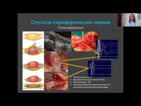 Интраоперационный нейрофизиологический мониторинг периферической нервной системы