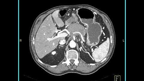 Abdomen: Pancreas: Pancreatic cancer : 3D mapping using volume rendering and MIP: Axial