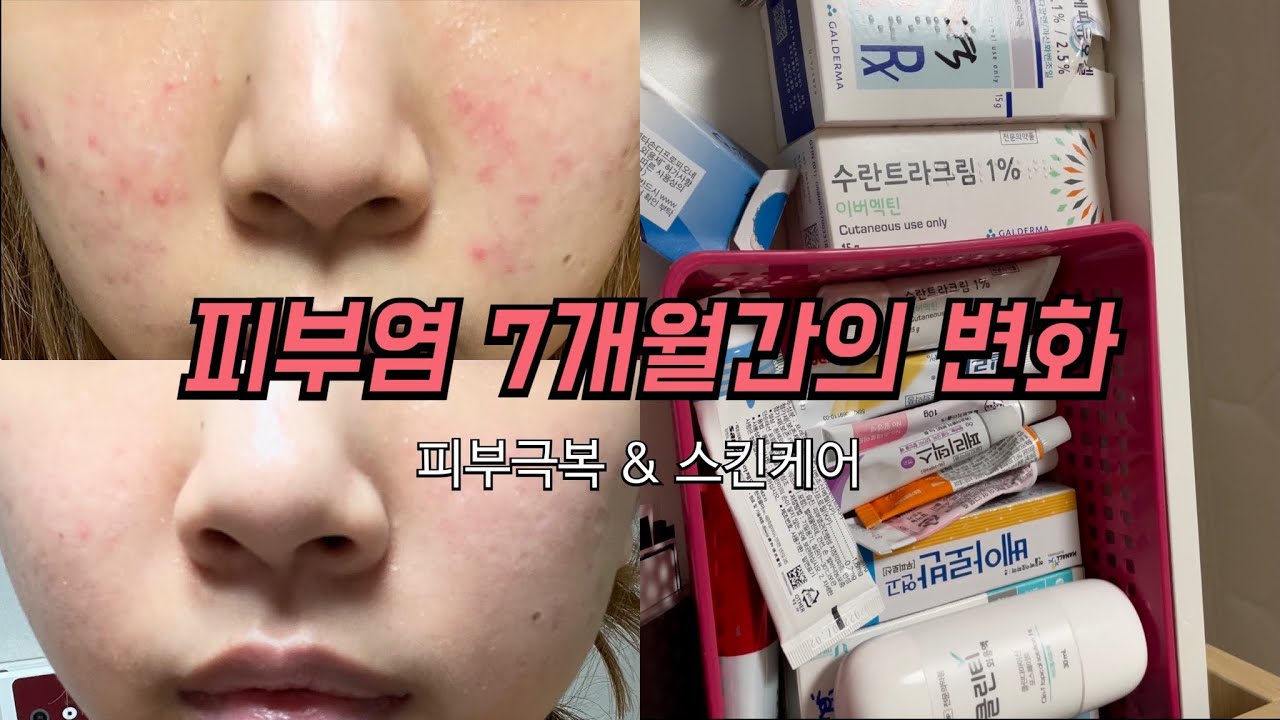 [vlog] 여러 피부과를 다녀도 안 나은 주사피부염,염증여드름 피부(수많은 시행착오 끝에 찾은 치료방법/스킨케어추천/얼굴열감|대학병원후기/한의원후기/한의원추천/피부염극복)