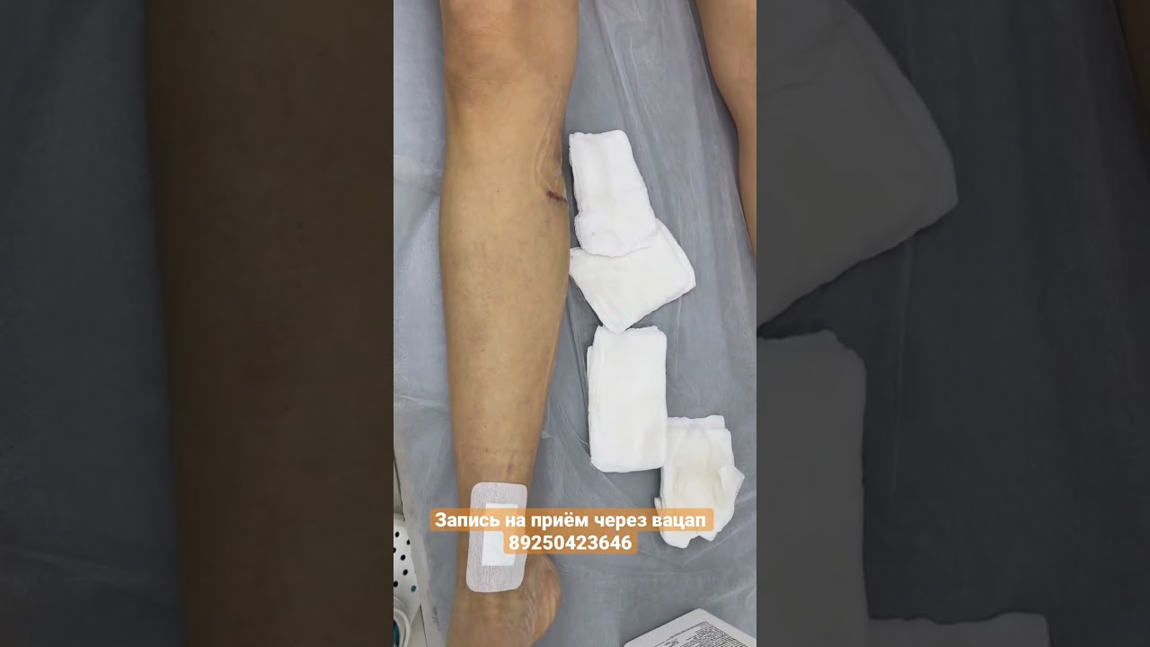 Нога после операции по удалению варикоза. Лечение варикоза. Флеболог ...