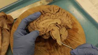 Sagittal Brain Dissection