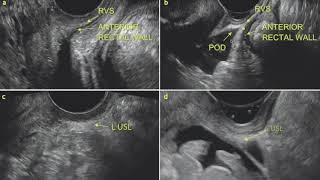 Saline-infusion sonoPODography (SPG): a novel technique in the diagnosis of endometriosis