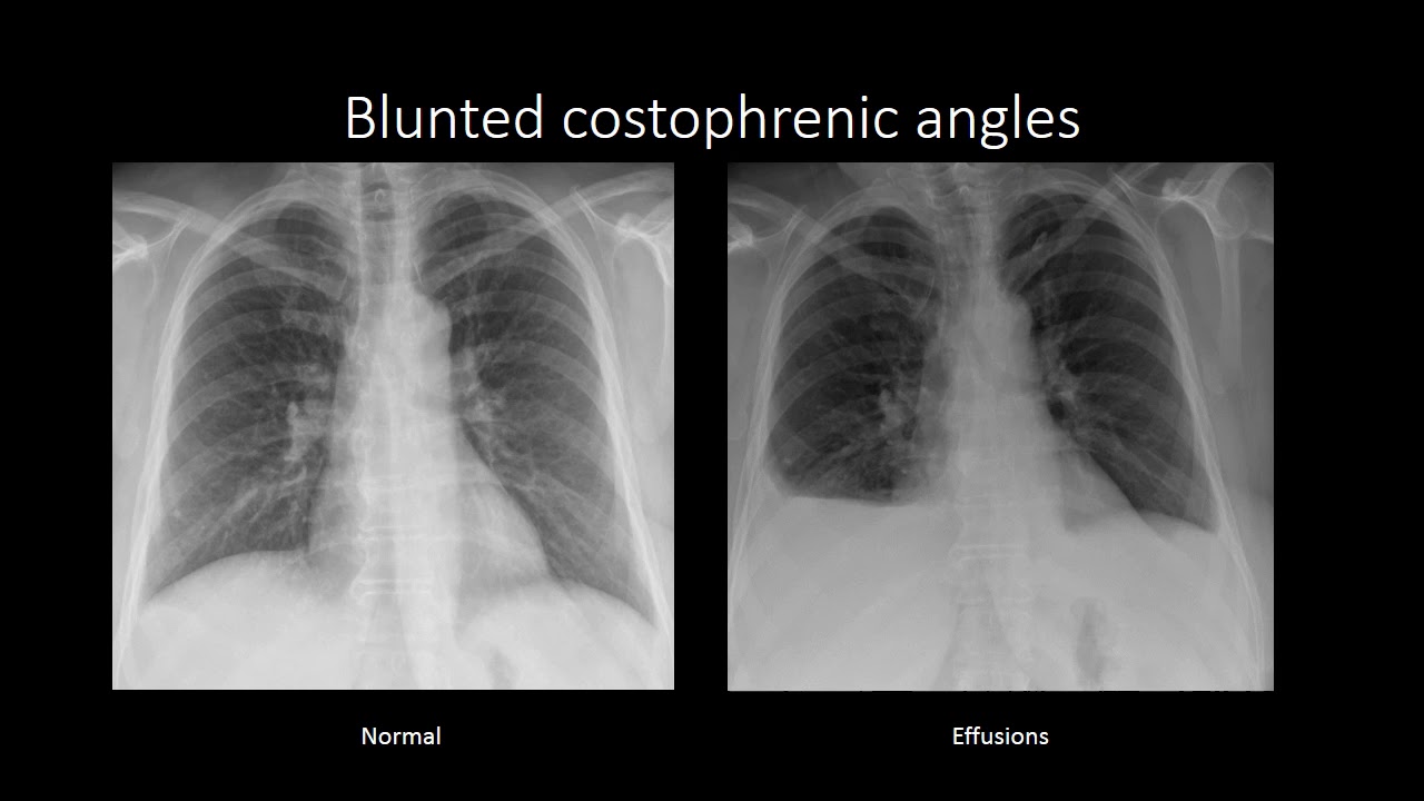 Costophrenic Angle Pleural Effusion