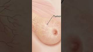 ब्रेस्ट कैंसर के शुरुवाती लक्षण क्या है  Women Breast में दिखें ये बदलाव तो Cancer का खतरा है