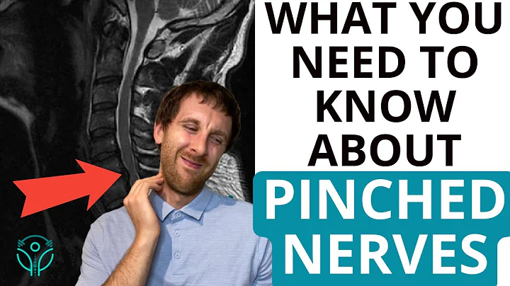 Cervical Radiculopathy: What To Know and What To Do | Aleks Physio