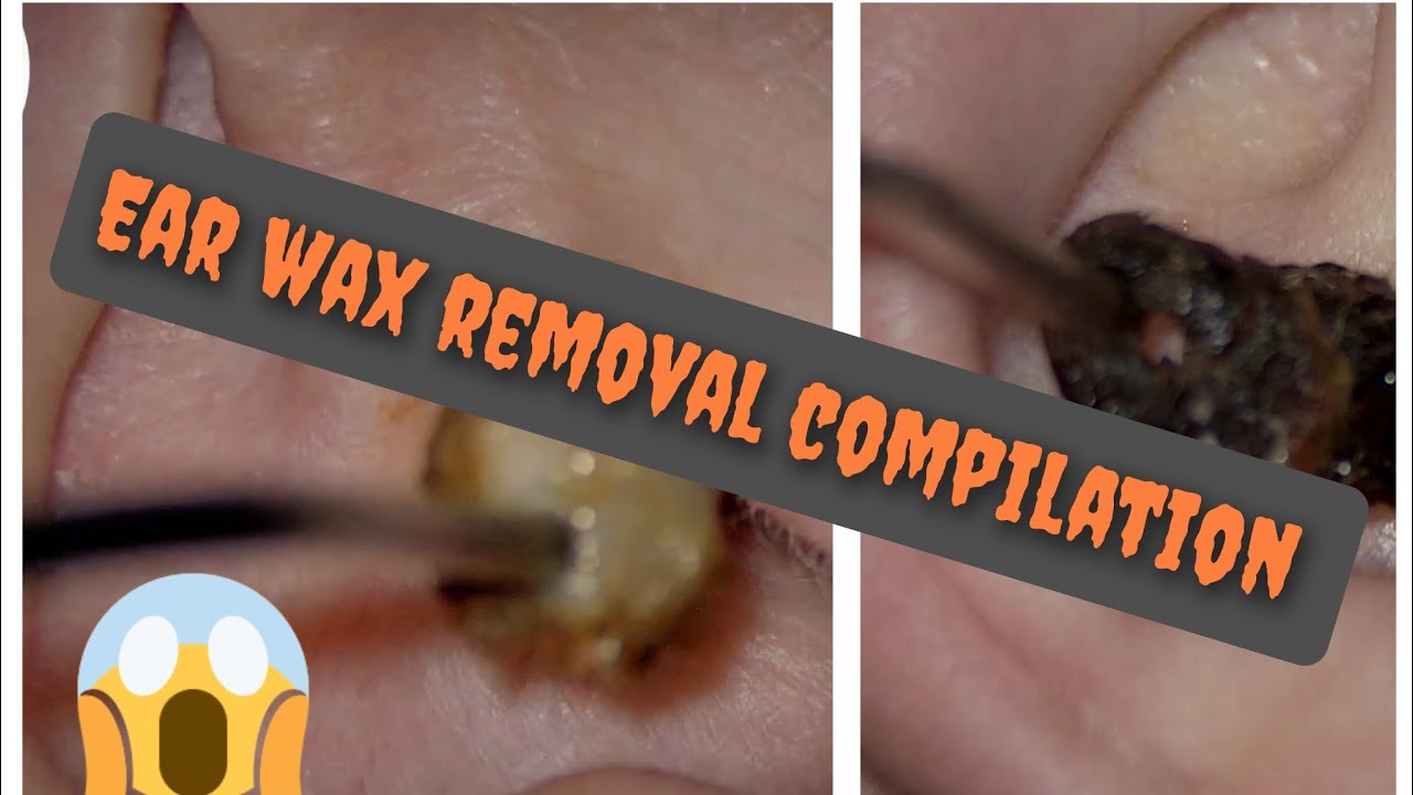 Ear wax removal compilation II earwax cerumenolytics earcleaning 