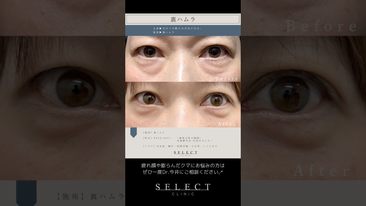 Dr.今井によるクマ取り『裏ハムラ術』🪄お悩みだった目の下の膨らみが綺麗になくなり若々しく見られるようになりました✨ #整形 #クマ取り #裏ハムラ #疲れ顔 #クマ #垢抜け #若見え