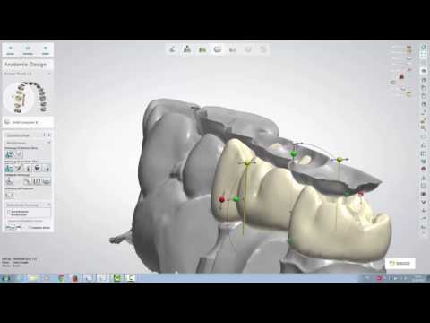 Design einer dreigliedrigen Brücke mit dem 3Shape Dental Designer 16.1.0 (für Einsteiger)