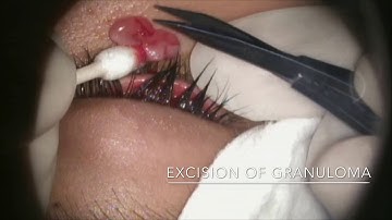 Excision Biopsy of Conjunctival Pyogenic Granuloma