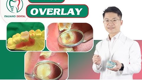 Phục hổi lại răng sau điều trị tuỷ bằng dán sứ overlay.