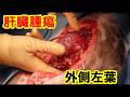 肝臓外側左葉腫瘍摘出術