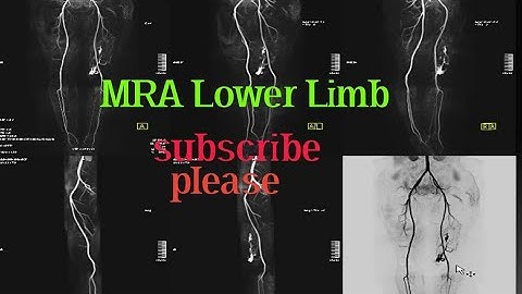 MRA Lower Limb angiogram.