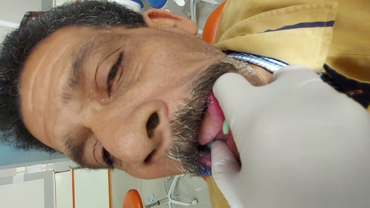 Part I (border molding) of lower 2ry Impression making for completely edentulous patient)