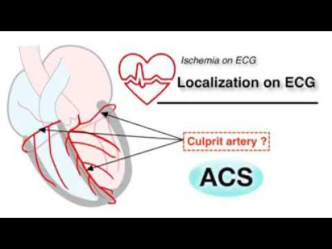 Video: Kesan Peningkatan Massa Ventrikel Kiri Pada Penilaian Iskemia Dalam Isyarat Elektrokardiografi: Kajian Jantung Teruk Arnab