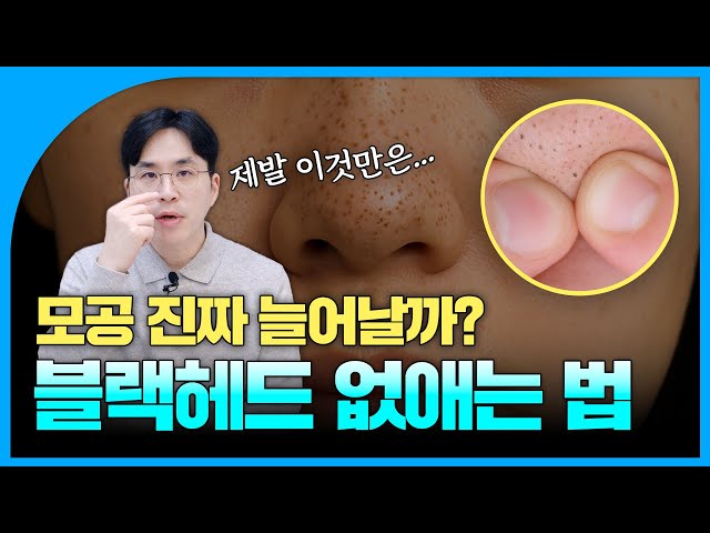 피지부자, 모공쟁이 필수 시청! 제발 이것만은 그만❌｜블랙헤드 제거