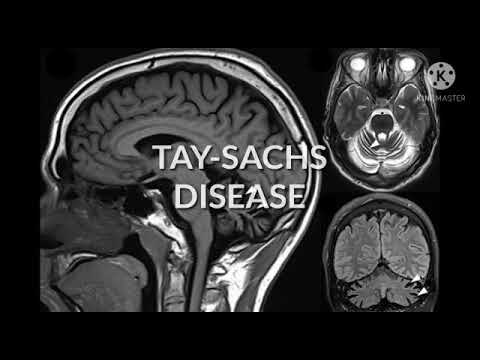 TAY-SACHS DISEASE FACTS U NEED TO KNOW