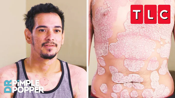 This Man's Psoriasis Is Taking Over His Life! | Dr. Pimple Popper | TLC