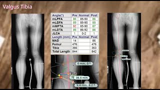 Osteotomy Planning Webinar with Mr. Raghbir Khakha