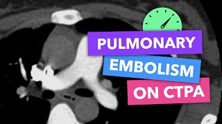 Pulmonary embolism on CTPA - Radiopaedia's Emergency Radiology Course