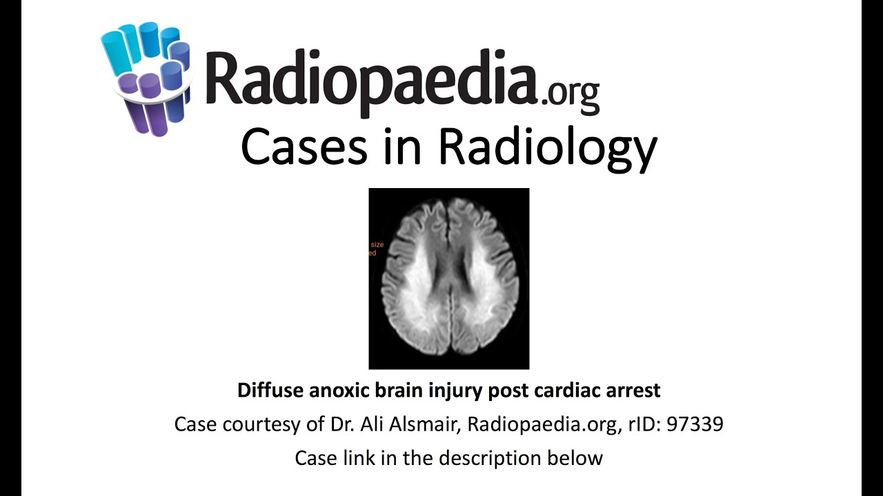 Diffuse Anoxic Brain Injury Post Cardiac Arrest Cases