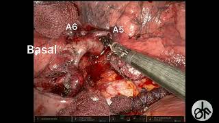 Robotic left lower lobectomy with hilar adenopathy complicated by bronchial lesion