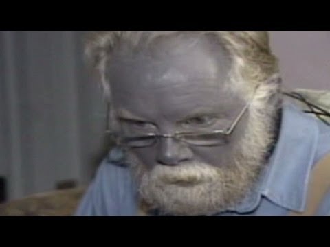 Bizarre 'Papa Smurf' resurfaces on the internet; know how overuse of  colloidal silver caused a man to turn blue