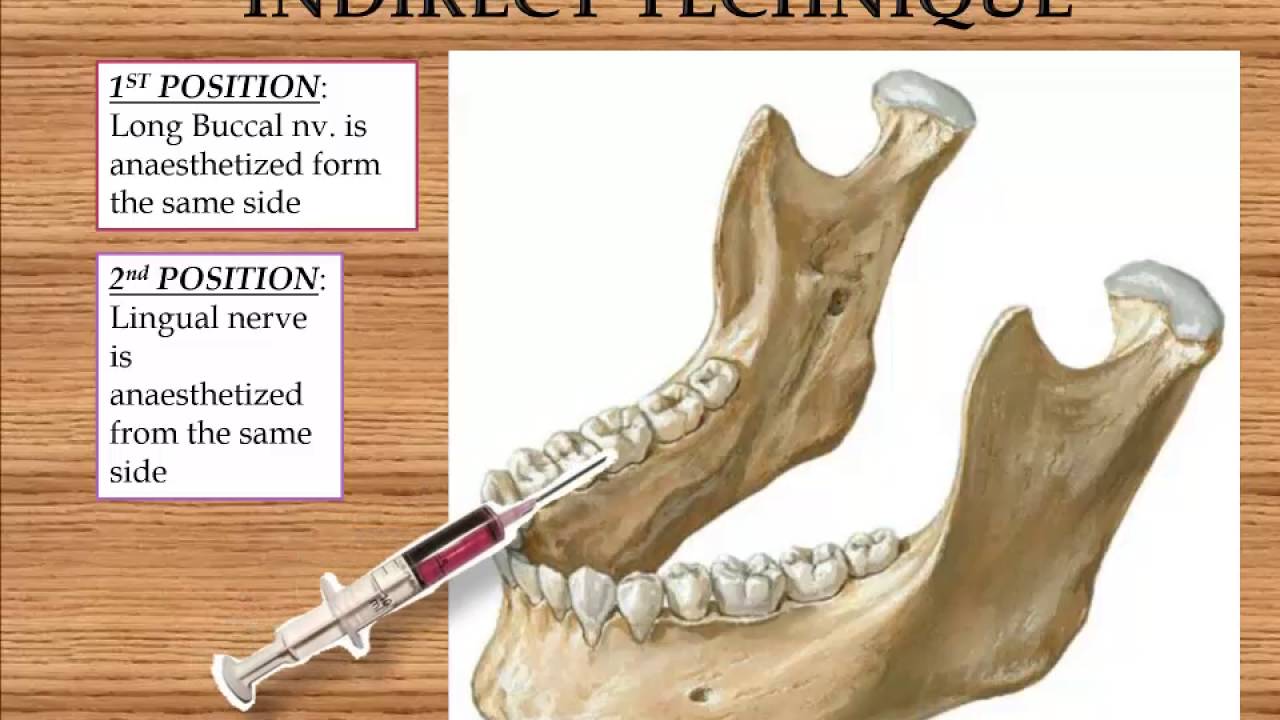 Video: Mandibular Anesthesia Inferior Alveolar Nerve Block, 43% OFF