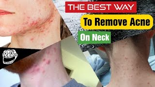 How To Get Rid Of Acne On Neck / Acne On Neck Treatment / Bestie Health