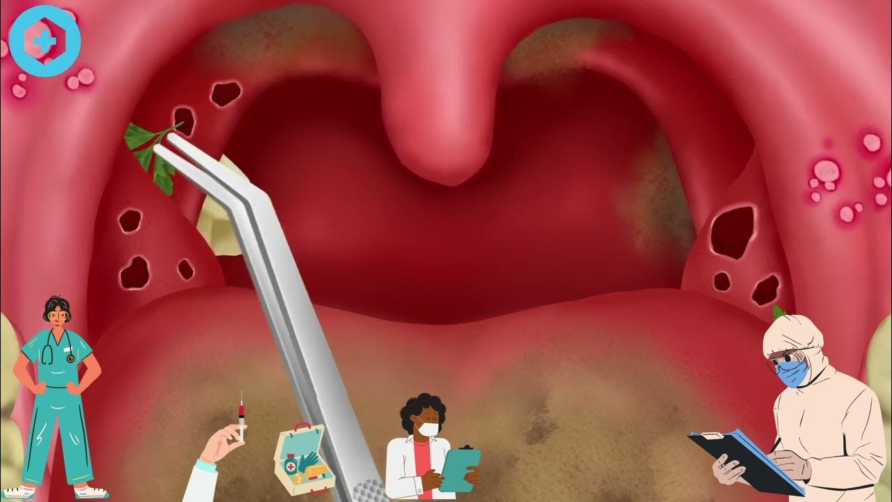 ASMR animation｜Pretty girl cleaning tonsil stones｜clean the tongue