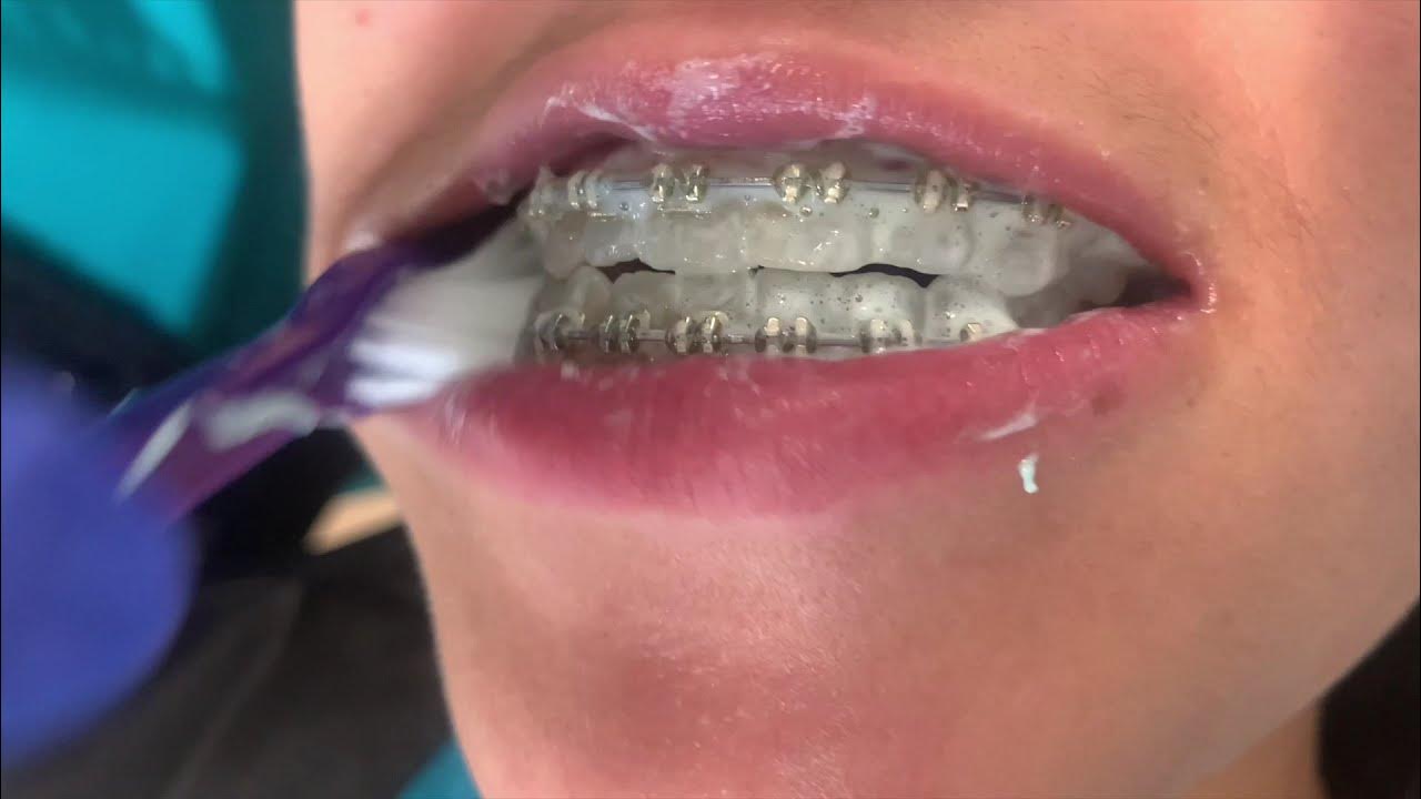 Brushing, Flossing, and Using the Proxabrush with TW Orthodontics YouTube