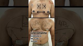 360° vs 360 Square vs Conventional Gynecomastia Surgery | Dr. Amit Explains the Difference