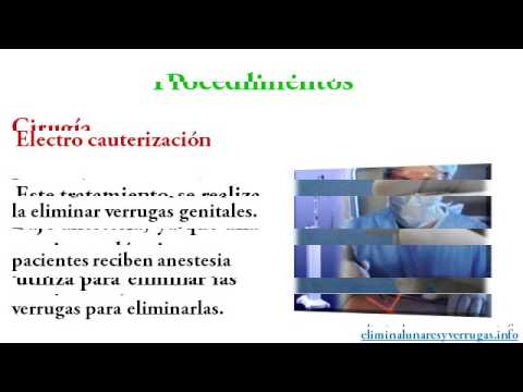 Como eliminar verrugas genitales (2da Parte)