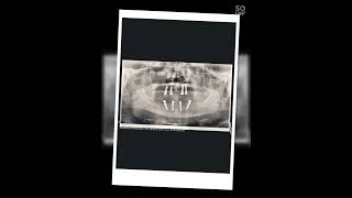 ALL ON 4  implants case (osstem)