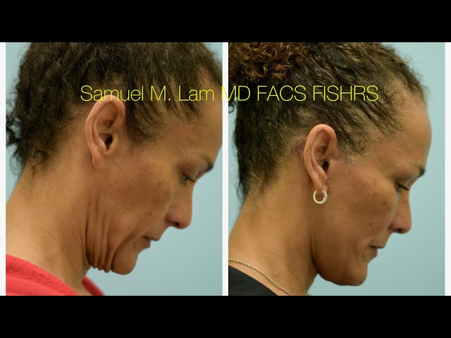 Deep Neck Fat Transfer Facelift Testimonials with Photos