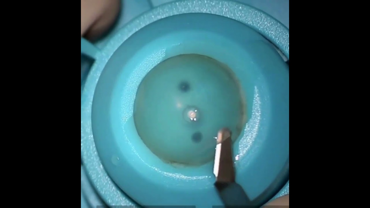 Manual Graft Preparation in DSEK
