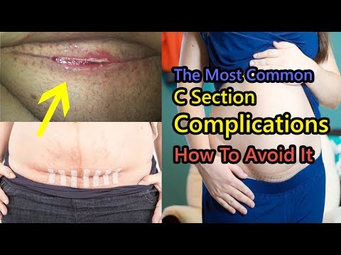 the-most-common-c-section-complications-&-how-to-avoid-it