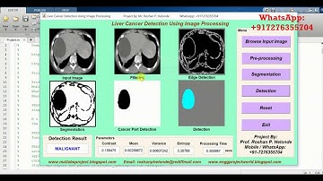 Liver Cancer Detection Using Image Processing Matlab Project Source Code