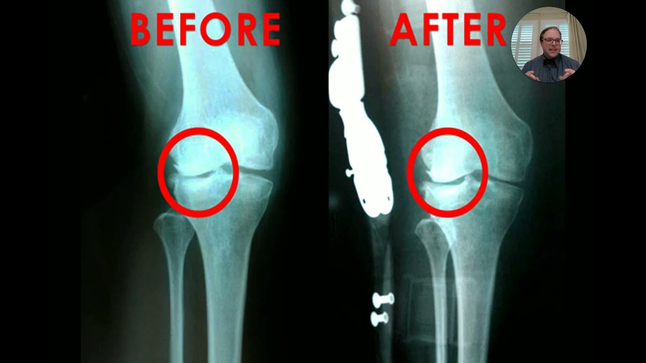 🦵 Advanced Arthritis Relief Protocol™ – 🔑 Turn-Key Knee OA Solution for Progressive Practices