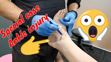 Master Chris Leong Tit Tar 跌打 Special case Ankle injury