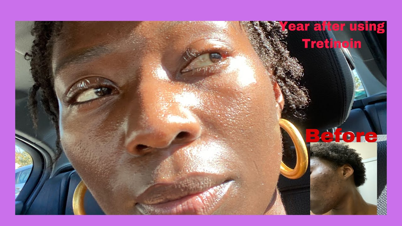 1 Year Update Using Tretinoin And Does it still Works On Darker Skin Complexion?