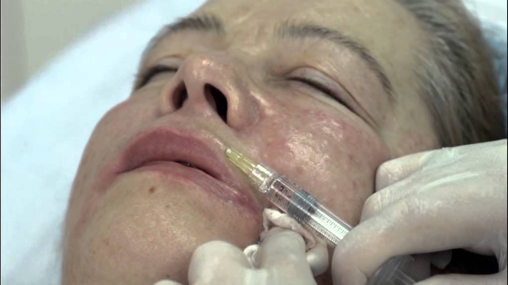 32 Redermalization of pursed lip wrinkles YouTube