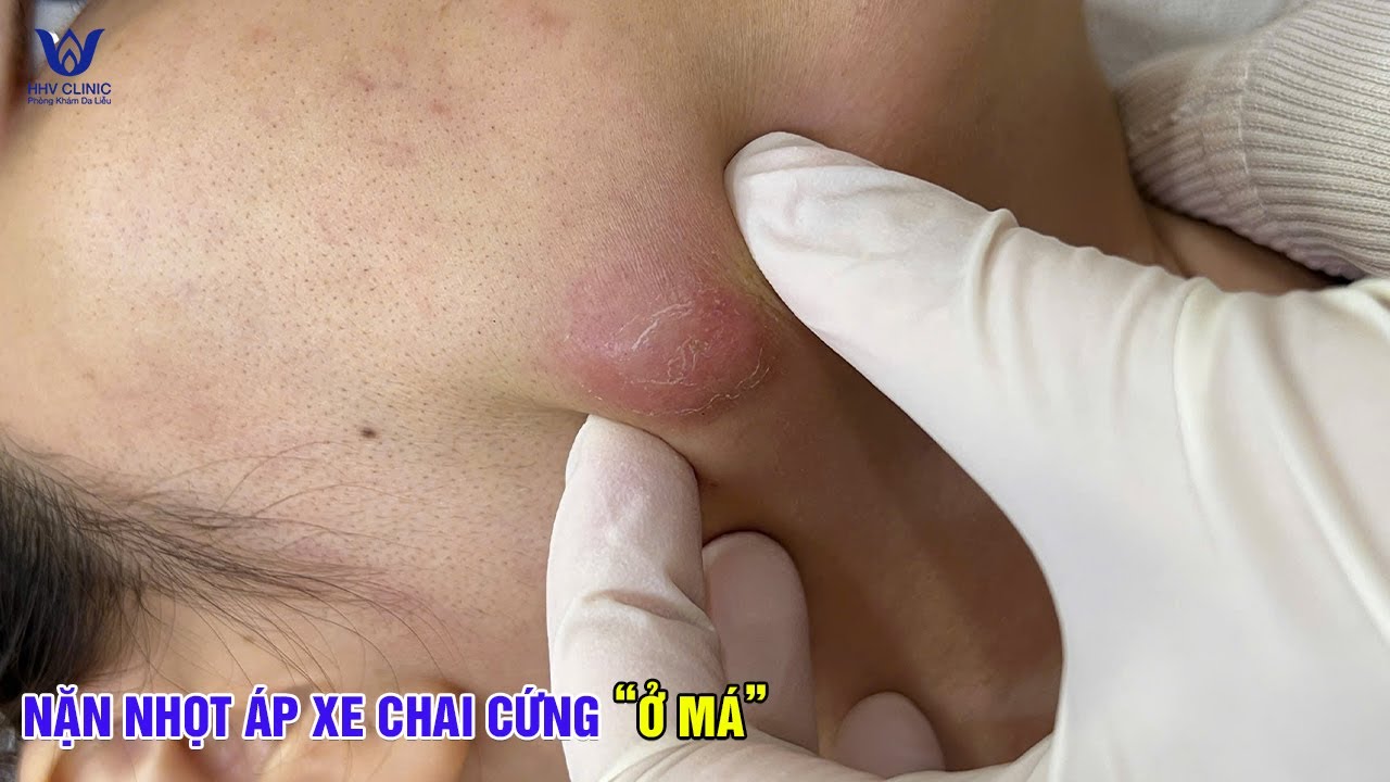 Nặn mụn áp xe ở má, chứa đầy mủ - Bác sĩ xử lý dứt điểm sau 1 buổi.