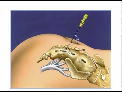 Surgical Treatment for Urges Incontinence
