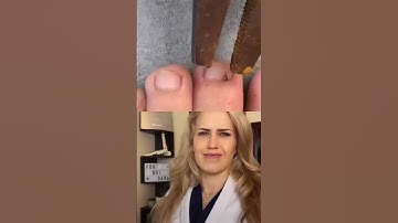 Thumbnail of #Doctor reacts: HUGE splinter removal