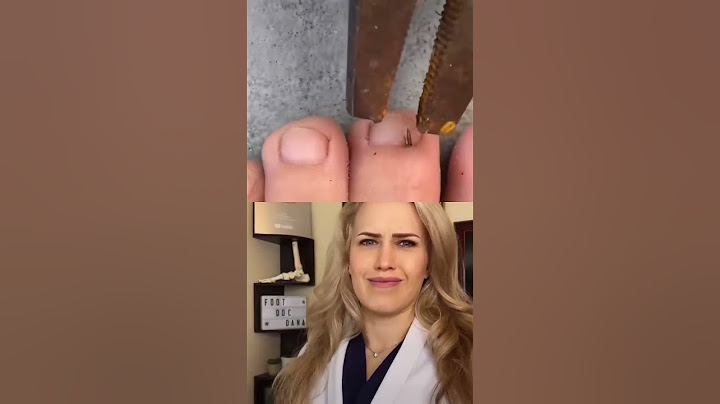 #Doctor reacts: HUGE splinter removal