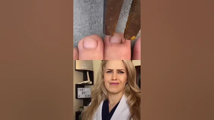 #Doctor reacts: HUGE splinter removal