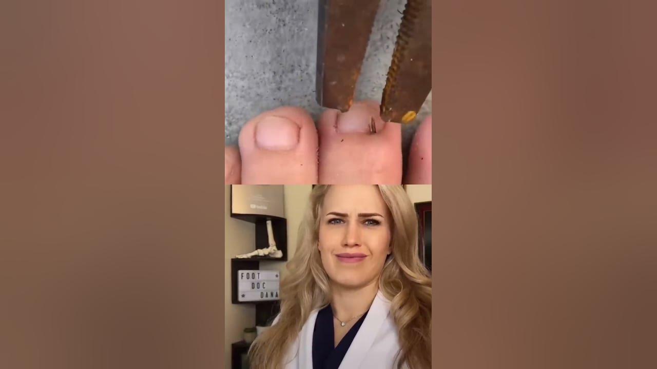 #Doctor reacts: HUGE splinter removal